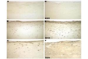 Sections of cartilage, showing immnostaining for galectin-3 from normal (A-C) and osteoarthritic cartilage (D-F).