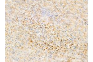 ABIN6255593 and ABIN6267543 at 1/100 staining human hepatocellular carcinoma by IHC-P. (Tuberin anticorps  (pThr1462))
