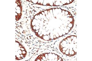 Immunohistochemistry of paraffin-embedded human colon carcinoma using Cytokeratin 13 (Cytokeratin 13 (KRT13)) antibody (ABIN7268090) at dilution of 1:100 (40x lens). (Cytokeratin 13 anticorps  (AA 269-458))