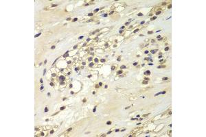 Immunohistochemistry of paraffin-embedded human kidney cancer using CHEK1 antibody (ABIN5975848) at dilution of 1/100 (40x lens).