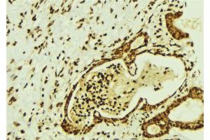 ABIN6274350 at 1/100 staining Human breast cancer tissue by IHC-P. (CBFB anticorps  (N-Term))
