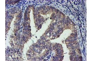 Immunohistochemical staining of paraffin-embedded Adenocarcinoma of Human endometrium tissue using anti-TCP11L2 mouse monoclonal antibody. (TCP11L2 anticorps)