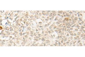 Immunohistochemistry of paraffin-embedded Human ovarian cancer tissue using OTX1 Polyclonal Antibody at dilution of 1:30(x200)