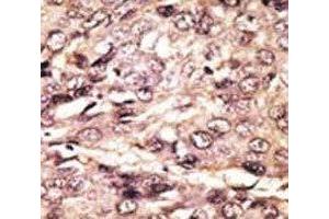 IHC analysis of FFPE human hepatocarcinoma tissue stained with the ATG7 antibody (ATG7 anticorps  (AA 494-523))