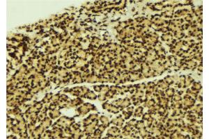 ABIN6269272 at 1/100 staining Human breast cancer tissue by IHC-P.