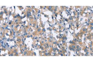 Immunohistochemistry of paraffin-embedded Human thyroid cancer using CDC25A Polyclonal Antibody at dilution of 1:50 (CDC25A anticorps)