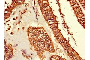 Immunohistochemistry of paraffin-embedded human endometrial cancer using ABIN7173699 at dilution of 1:100