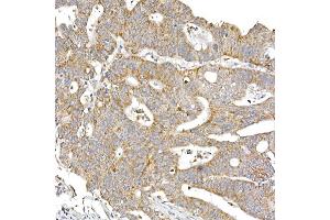 Immunohistochemistry of paraffin-embedded human colon carcinoma using S Rabbit mAb (ABIN7270501) at dilution of 1:250 (40x lens). (SAMM50 anticorps)