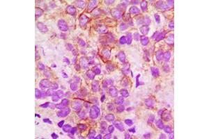 Immunohistochemical analysis of Cytochrome P450 2B6 staining in human breast cancer formalin fixed paraffin embedded tissue section.