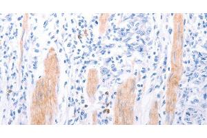 Immunohistochemistry of paraffin-embedded Human gasrtic cancer tissue using LPAR2 Polyclonal Antibody at dilution 1:40 (EDG4 anticorps)