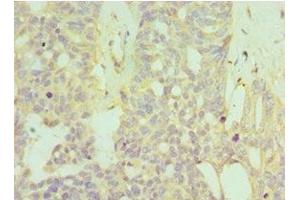Immunohistochemistry of paraffin-embedded human endommetrial cancer using ABIN7155969 at dilution of 1:100 (HYAL1 anticorps  (AA 136-435))