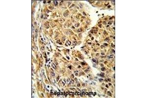 Formalin-fixed and paraffin-embedded human hepatocarcinoma reacted with CYP2C19 Antibody (N-term),which was peroxidase-conjugated to the secondary antibody, followed by DAB staining.