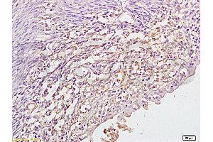 Formalin-fixed and paraffin embedded human cervical cancer labeled with Anti P45017A1 Polyclonal Antibody,Unconjugated (ABIN720071) at 1:200 followed by conjugation to the secondary antibody and DAB staining.