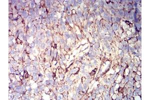 Immunohistochemical analysis of paraffin-embedded bladder cancer tissues using CD44 mouse mAb with DAB staining. (CD44 anticorps  (AA 36-194))