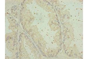 Immunohistochemistry of paraffin-embedded human prostate cancer using ABIN7168124 at dilution of 1:100