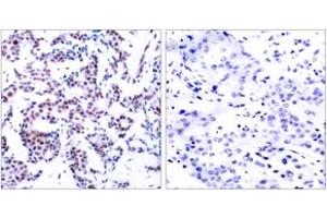 Immunohistochemistry analysis of paraffin-embedded human breast carcinoma, using JunB (Phospho-Ser259) Antibody.