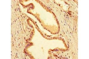 Immunohistochemistry of paraffin-embedded human prostate cancer using ABIN7155782 at dilution of 1:100 (MEIS1 anticorps  (AA 1-90))