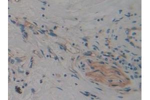 Detection of CARD9 in Human Lung cancer Tissue using Polyclonal Antibody to Caspase Recruitment Domain Family, Member 9 (CARD9)