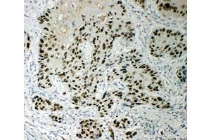 IHC-P: p63 antibody testing of human esophageal squamous cell carcinoma tissue (TCP1 alpha/CCTA anticorps  (AA 82-98))