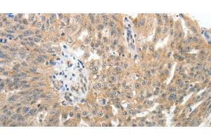 Immunohistochemistry of paraffin-embedded Human ovarian cancer tissue using E-Selectin Polyclonal Antibody at dilution of 1:40 (Selectin E/CD62e anticorps)