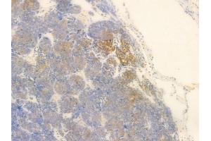 LAT Antibody at 1/100 staining human thymoma by IHC-P. (LAT anticorps  (C-Term))