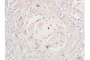 Formalin-fixed and paraffin-embedded human cervical carcinoma labeled with Rabbit Anti-Ki-67 Polyclonal Antibody, Unconjugated at 1:200 followed by conjugation to the secondary antibody and DAB staining (Ki-67 anticorps  (AA 1201-1300))