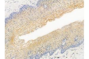 ABIN6256357 and ABIN6267416 at 1/100 staining human cervical carcinoma by IHC-P.