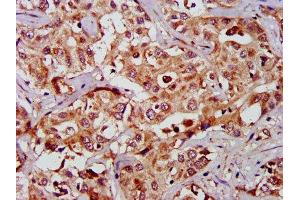 IHC image of ABIN7154482 diluted at 1:1000 and staining in paraffin-embedded human liver cancer performed on a Leica BondTM system. (GAS2 anticorps  (AA 1-141))