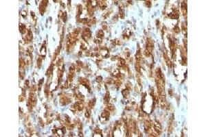 IHC testing of FFPE rhabdomyosarcoma with Muscle Actin antibody (Actin anticorps)