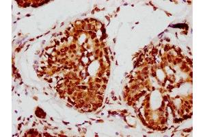 IHC image of ABIN7127601 diluted at 1:115 and staining in paraffin-embedded human breast cancer performed on a Leica BondTM system.