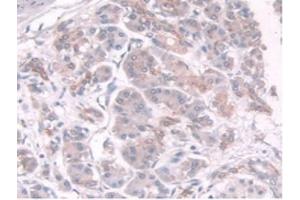 IHC-P analysis of Human Pancreas Cancer Tissue, with DAB staining. (TPMT anticorps  (AA 26-227))