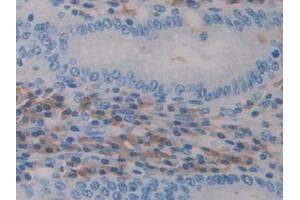 Detection of ADAM10 in Human Stomach cancer Tissue using Polyclonal Antibody to A Disintegrin And Metalloprotease 10 (ADAM10)