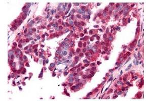 Affinity Purified anti-EGR-1 antibody was used at a 10 ug/ml to detect nuclear and cytoplasmic signal with low background staining in a variety of tissues including multi-human, multi-brain and multi-cancer slides.