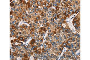 Immunohistochemistry of Human thyroid cancer using SLAMF8 Polyclonal Antibody at dilution of 1:40