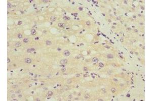 Immunohistochemistry of paraffin-embedded human liver cancer using ABIN7172635 at dilution of 1:100