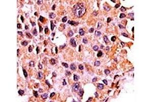 IHC analysis of FFPE human breast carcinoma tissue stained with the Calcineurin antibody (CAN anticorps  (AA 21-51))