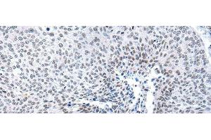 Immunohistochemistry of paraffin-embedded Human lung cancer tissue using MORC2 Polyclonal Antibody at dilution of 1:25(x200) (MORC2 anticorps)