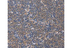 Immunohistochemistry of Human liver cancer using CD5L Polyclonal Antibody at dilution of 1:40 (CD5L anticorps)