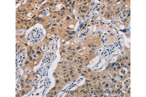 Immunohistochemistry of Human lung cancer using TLR3 Polyclonal Antibody at dilution of 1:50 (TLR3 anticorps)