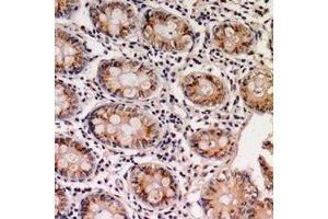 Immunohistochemical analysis of EPS8L1 staining in human colon cancer formalin fixed paraffin embedded tissue section. (EPS8-Like 1 anticorps)