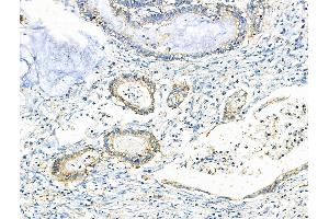 ABIN6259590 and ABIN6275930 at 1/100 staining Human gastric cancer by IHC-P. (BUD31 anticorps  (N-Term))