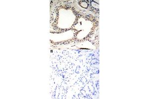 Immunohistochemical staining of human breast cancer tissue by Nfkbie (phospho S22) polyclonal antibody  without blocking peptide (A) or preincubated with blocking peptide (B) under 1:50-1:100 dilution. (NFKBIE anticorps  (pSer22))