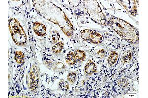 Formalin-fixed and paraffin embedded human colon carcinoma labeled with Rabbit Anti-JAK2 Polyclonal Antibody (ABIN730513), Unconjugated 1:200 followed by conjugation to the secondary antibody and DAB staining