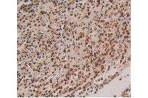 IHC-P analysis of Human Rectum Cancer Tissue, with DAB staining. (S100P anticorps  (AA 1-95))