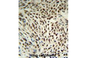 SNRPD3 Antibody (C-term) IHC analysis in formalin fixed and paraffin embedded human lung carcinoma followed by peroxidase conjugation of the secondary antibody and DAB staining.