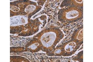 Immunohistochemistry of Human colon cancer using GJB4 Polyclonal Antibody at dilution of 1:40 (GJB4 anticorps)