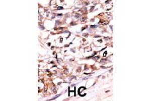 Formalin-fixed and paraffin-embedded human hepatocellular carcinoma tissue reacted with DUSP13 polyclonal antibody  , which was peroxidase-conjugated to the secondary antibody, followed by AEC staining. (DUSP13 anticorps  (N-Term))