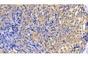 Detection of Bcl2L2 in Human Breast cancer Tissue using Polyclonal Antibody to B-Cell CLL/Lymphoma 2 Like Protein 2 (Bcl2L2)