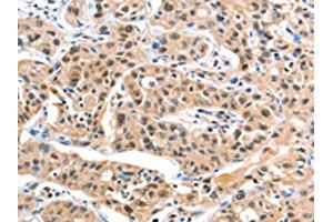 The image on the left is immunohistochemistry of paraffin-embedded Human liver cancer tissue using ABIN7129182(DDX4 Antibody) at dilution 1/20, on the right is treated with fusion protein. (DDX4 anticorps)