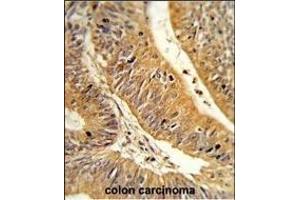 Formalin-fixed and paraffin-embedded human colon carcinoma reacted with CXXC4 Antibody (C-term), which was peroxidase-conjugated to the secondary antibody, followed by DAB staining.